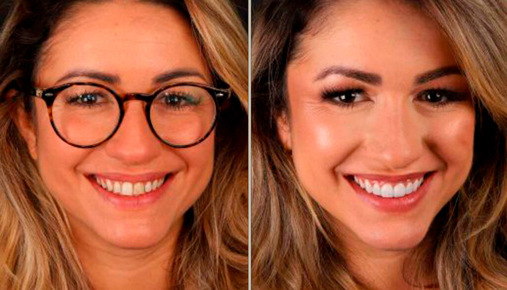 Reabilitação Estética com Lentes de Contato Dental Barra da Tijuca